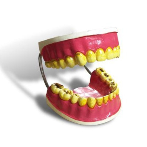 흡연으로 인해 변색된 치아모형[KIM3-18]